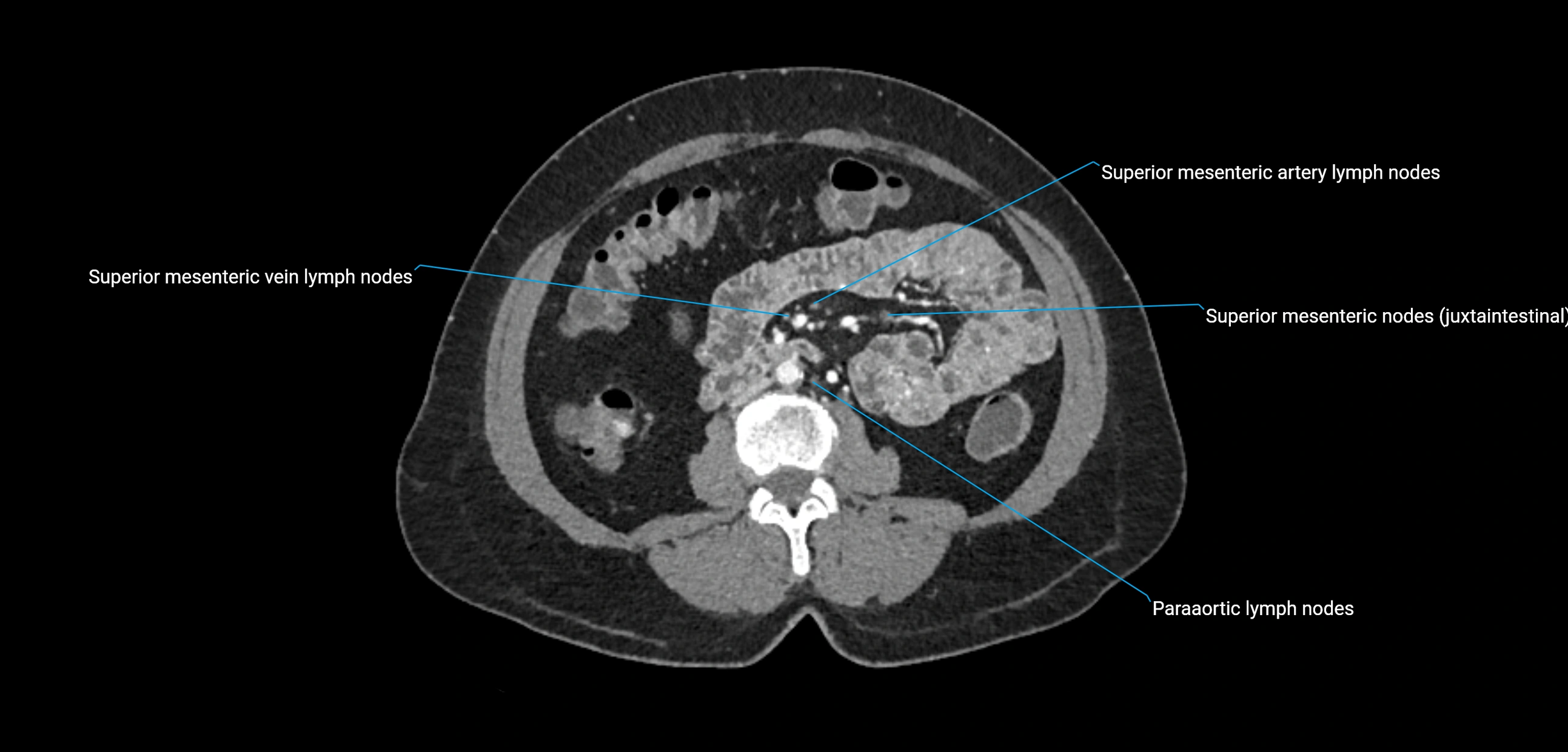 CT ct abdominal lymph nodes  axial cross sectional anatomy  enchanced radiology image -img-00002-00225.webp